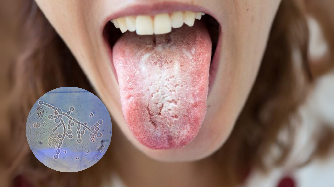 Principales síntomas del hongo Candida albicans que no debes ignorar